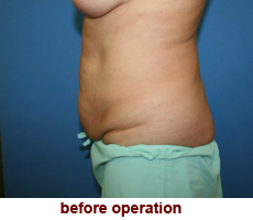 plastic-surgery-tummy-tuck